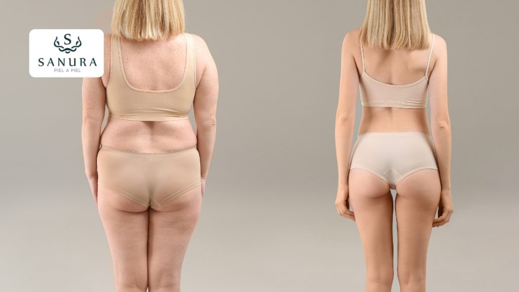 23.2 lipoescultura antes y después