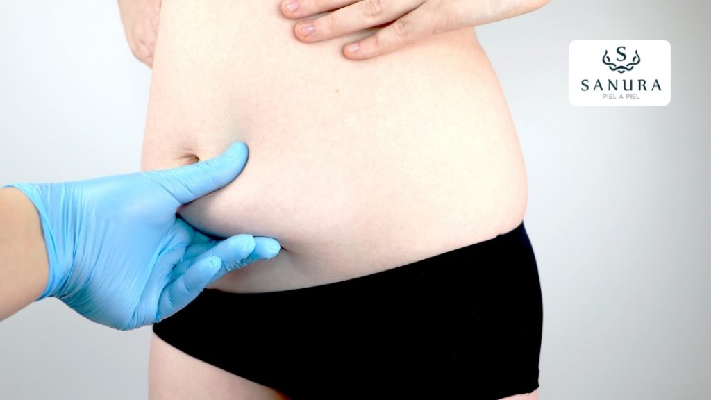25.1 abdominoplastia quito