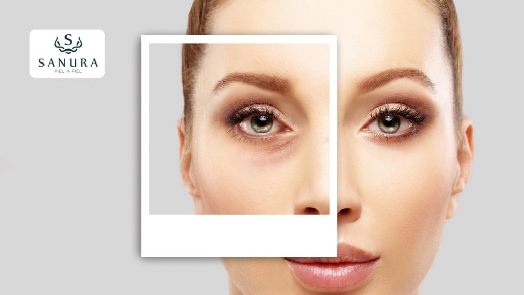 50.1 blefaroplastia inferior