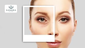 50.1 blefaroplastia inferior