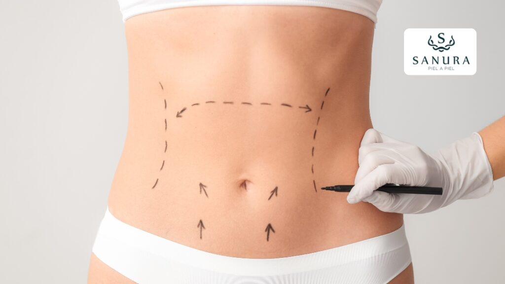 67.1 abdominoplastia qué es