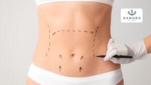 67.1 abdominoplastia qué es
