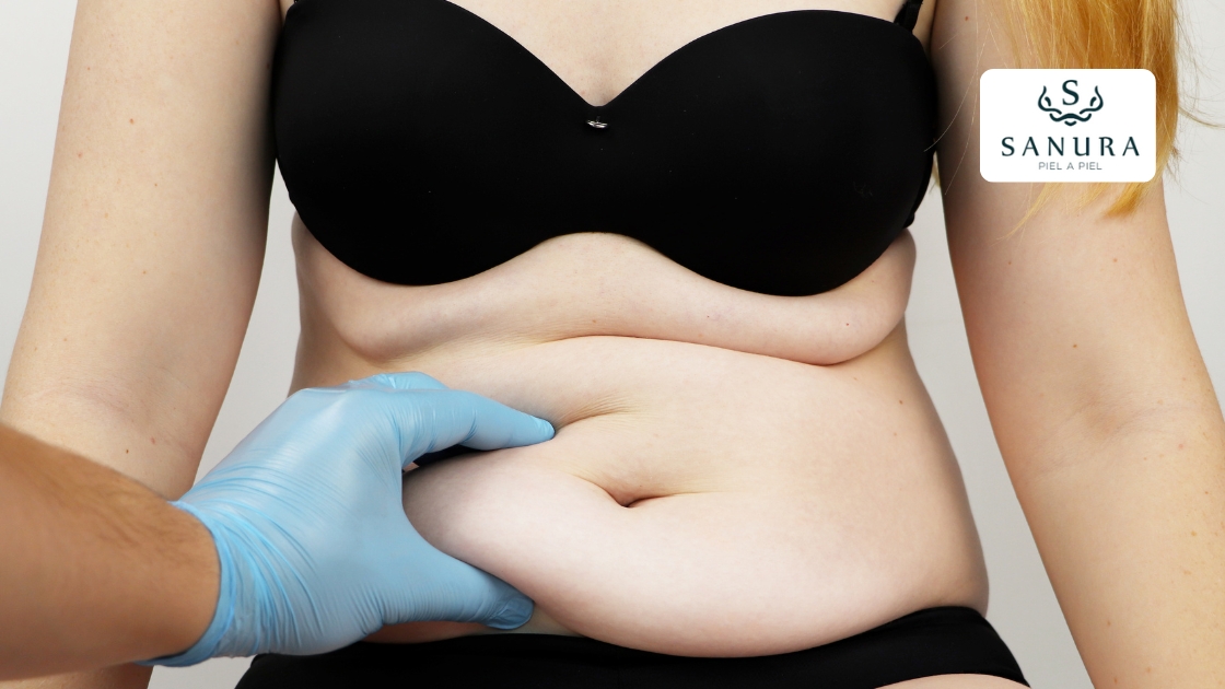 67.2 abdominoplastia qué es