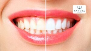 69.1 blanqueamiento dental con laser
