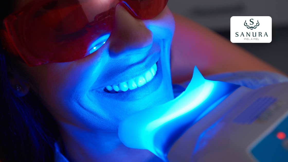 69.2 blanqueamiento dental con laser