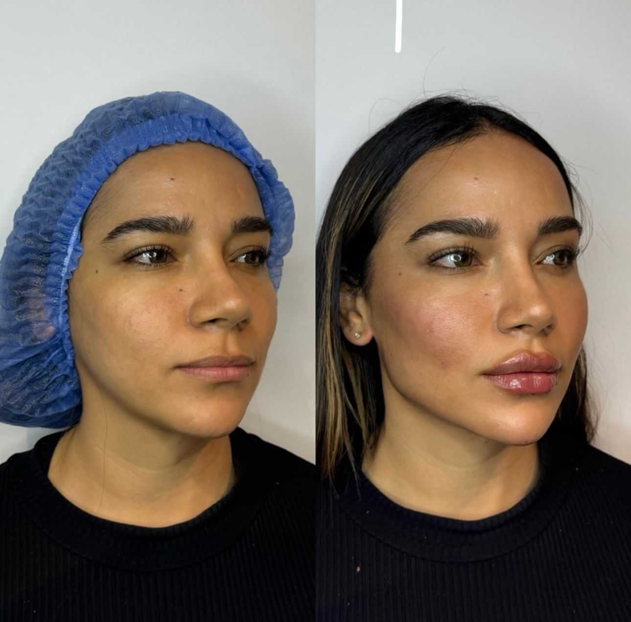 Armonización facial