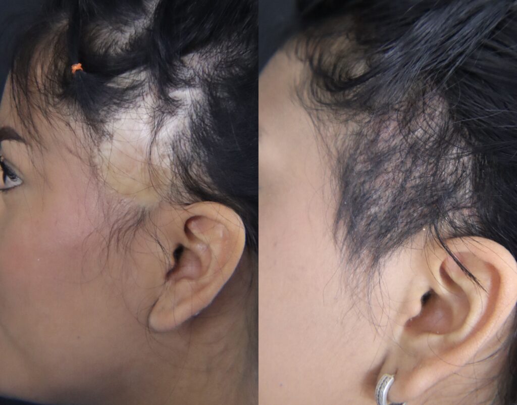 transplante capilar cicatriz