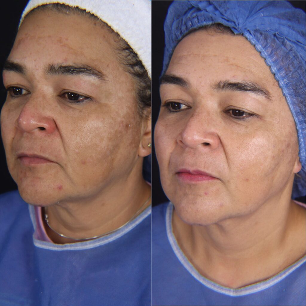 Melasma quito