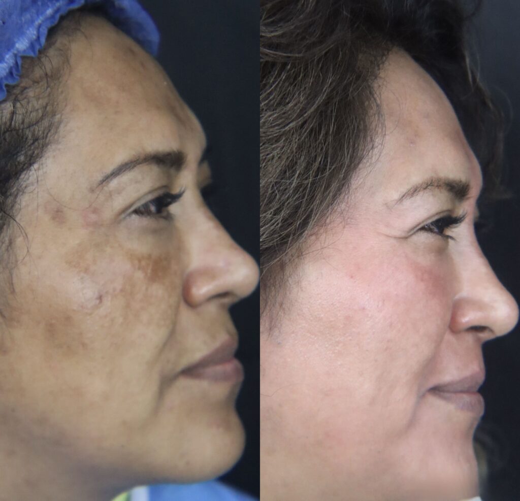 Tratamiento de melasma sanura