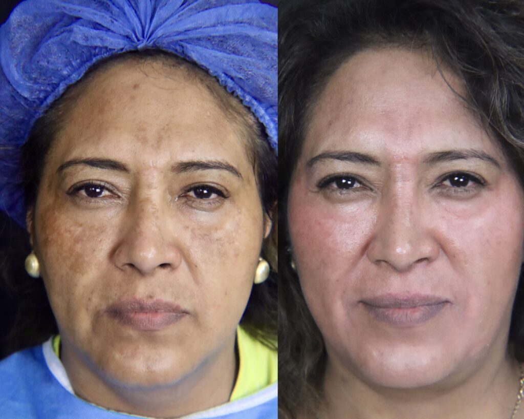 Melasma