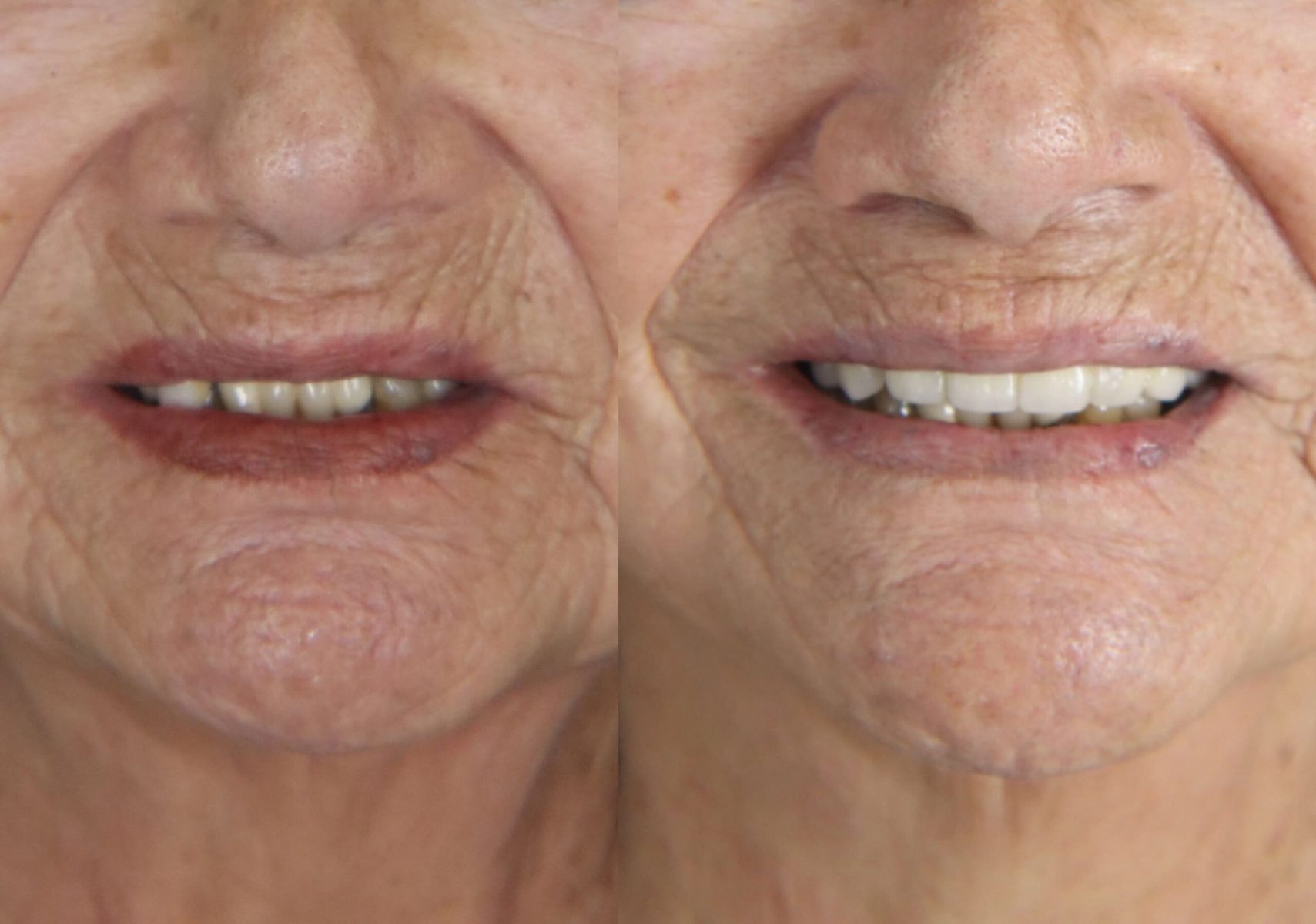 Implantes dentales Implantes dentales